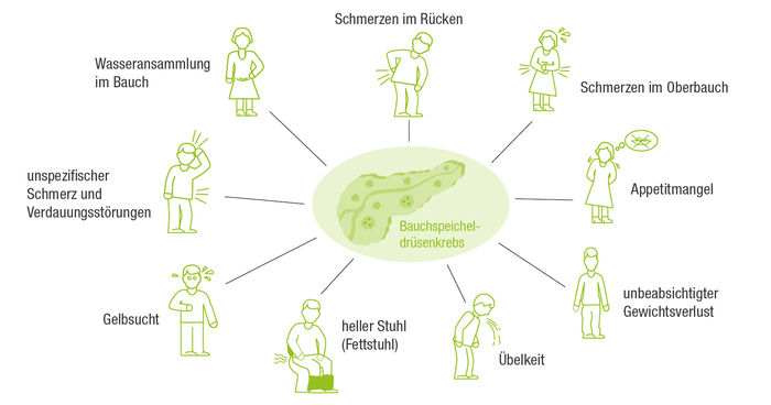 Grafik mit verschiedenen Symptomen von Bauchspeicheldrüsenkrebs