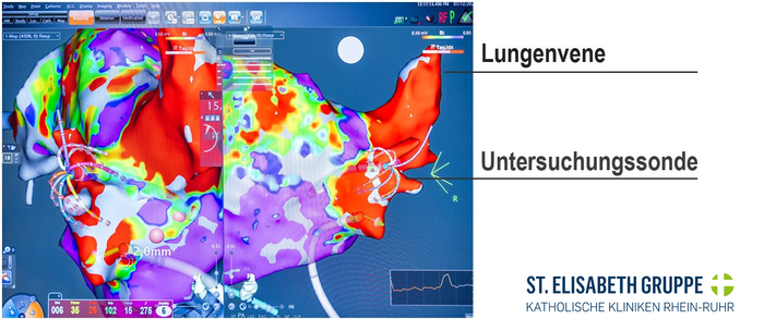 Elektrophysiologisches Mapping 3D Ansicht des Herzens