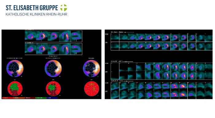 Myokardszintigrafie: Große Narbe in Vorder- und Hinterwand des Herzens