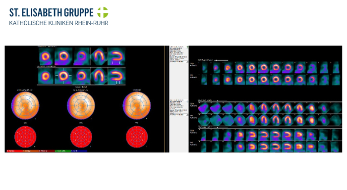 Myokardszintigrafie: Normalbefund