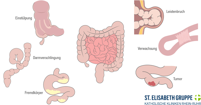 Medizinische Darstellung der Ursachen eines mechanischen Ileus.