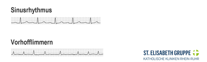 EKG Ableitungen Vergleich von Sinusrhythmus und Vorhofflimmern