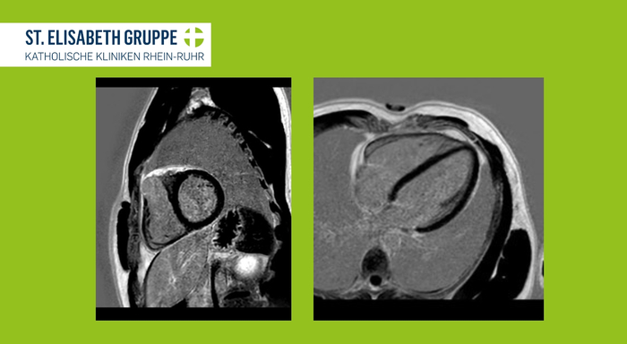 Herz-MRT zur Beurteilung von Herzerkrankungen