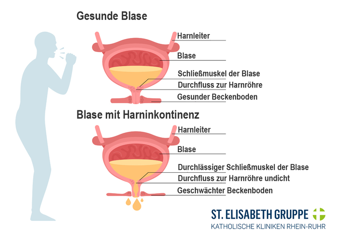Belastungsharninkontinenz auch Stressinkontinenz Schaubild