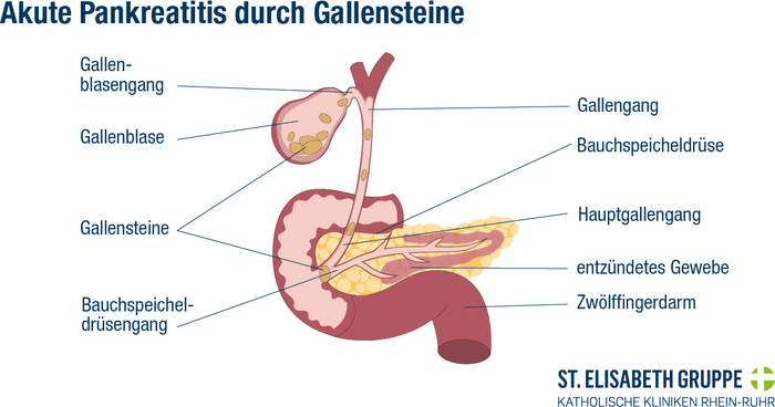 Illustrative Darstellung einer akuten Pankreatitis, die durch einen Verschluss durch Gallensteine verursacht wurde