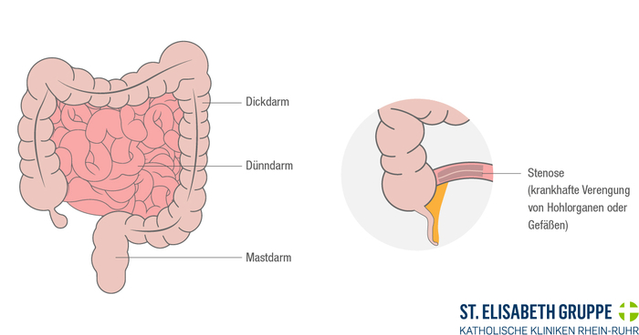 Grafische Darstellung: Typische Lokalisationen von mechanischem Darmverschluss und Darmlähmung.