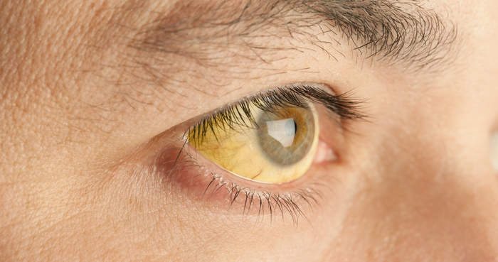 Gelb verfärbte Augen sind ein Hinweis auf eine Gelbsucht. Beim Bauchspeicheldrüsenkrebs ist diese meist schmerzlos.