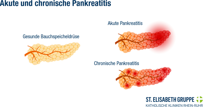 Illustrative Darstellung einer gesunden Bauchspeicheldrüse im Vergleich zu einem akuten bzw. chronisch entzündeten Organ