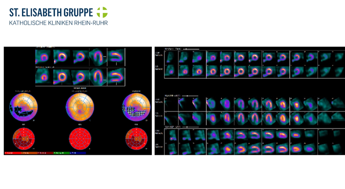 Myokardszintigrafie: Ischämie in der Hinterwand des Herzens