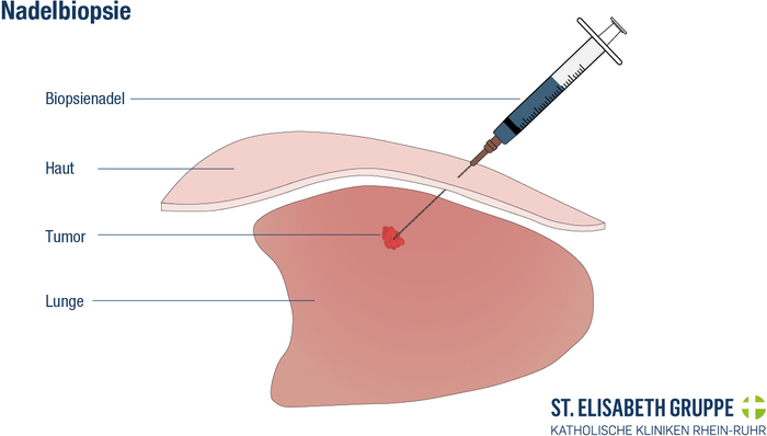 Schematische Darstellung einer Nadelbiopsie zur Gewebeentnahme.