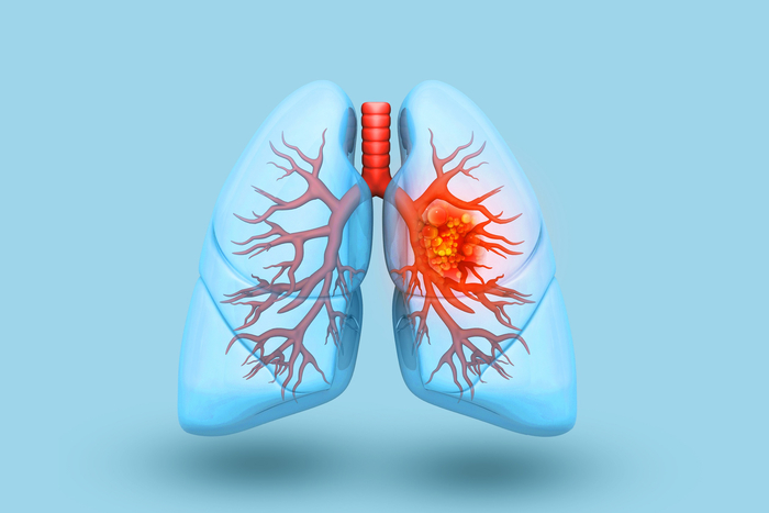 3D-Illustration von Lungenkrebs/Bronchialkarzinom.