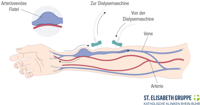 Funktionsweise einer AV-Fistel: Durch die direkte Verbindung von Arterie und Vene wird der Blutfluss in der Vene erhöht. Dies führt zur 'Reifung' – die Vene dehnt sich aus und ihre Wand verdickt sich, wodurch sie für die Dialysepunktion robust genug wird.