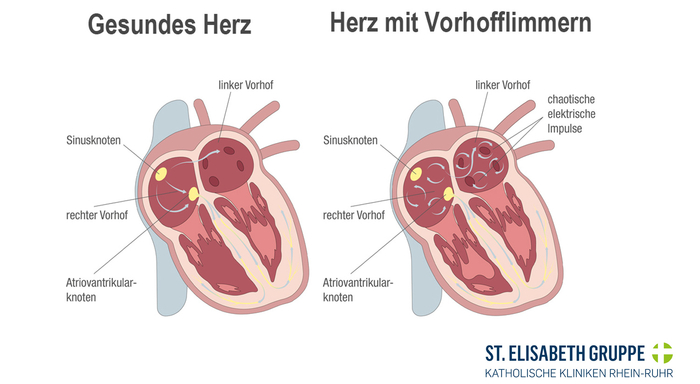 Inforgrafik Unterschied zwischen einem Herz mit Vorhofflimmern und einem gesunden Herz