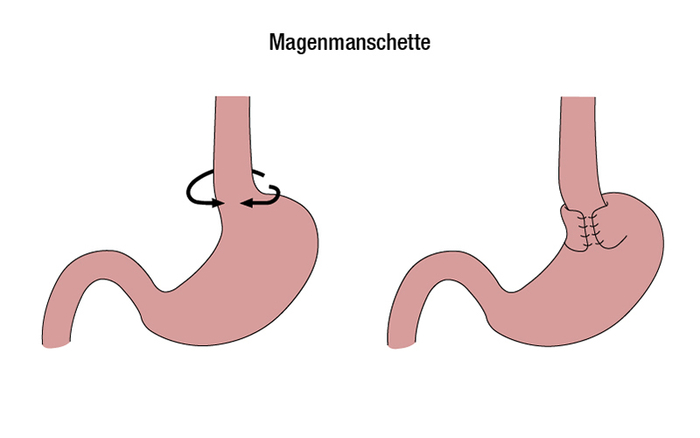 Operation der Refluxkrankheit: Eine Magenmanschette verhindert das Aufsteigen von Magensäure in die Speiseröhre.