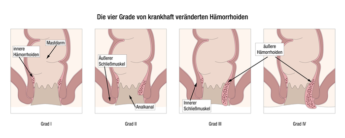 Eine Grafik zeigt die vier verschiedenen Grade einer Hämorrhoiden-Erkrankung. Jeder Grad wird durch eine Abbildung veranschaulicht. Die Hämorrhoiden werden mit ansteigendem Grad entsprechend größer.