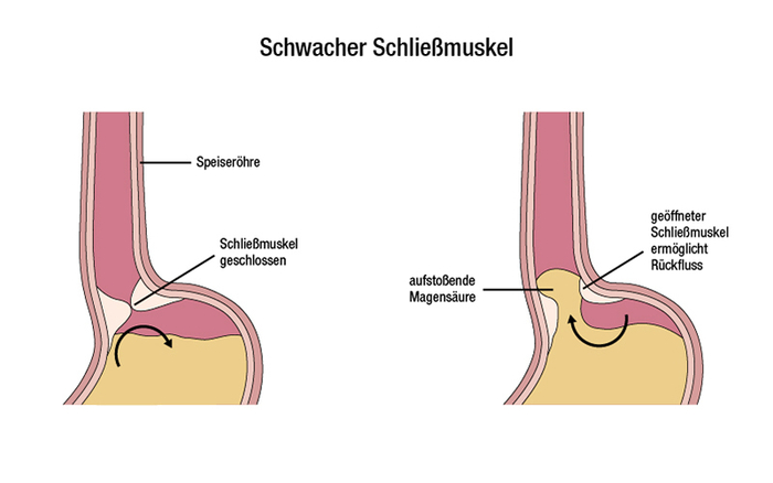 Schwacher Schließmuskel bei einer Refluxkrankheit
