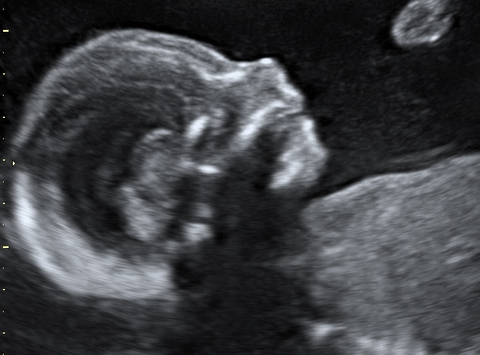 Profil eines Feten in Schwangerschaftswoche 12 im Ultraschallbild