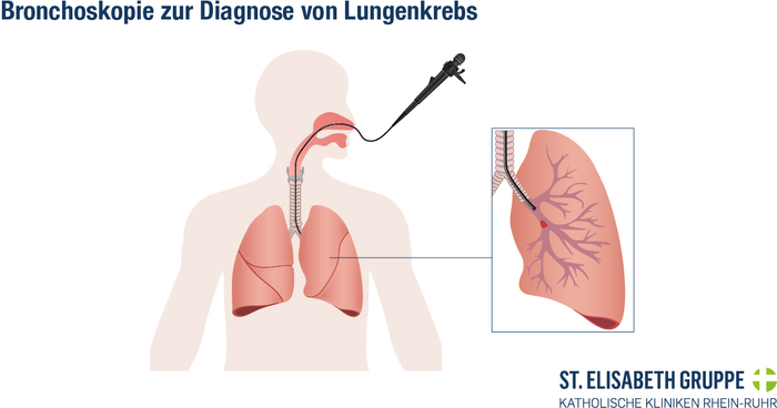 Darstellung einer Bronchoskopie beim Menschen.