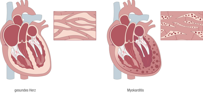 Bei einer Herzmuskelentzündung (Myokarditis) ist der Herzmuskel entzündet.