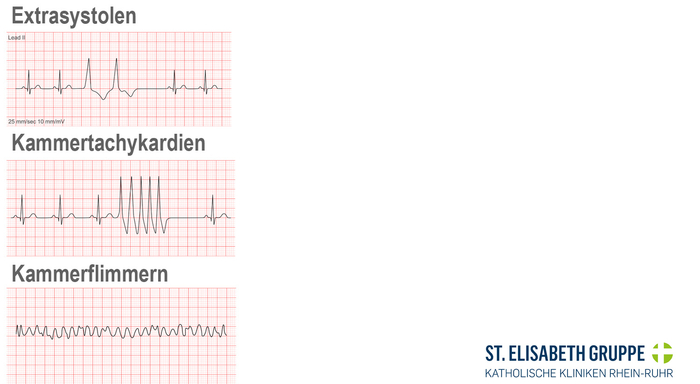 Vergleich Kammerflimmern, Extrasystolen und Kammertachykardien