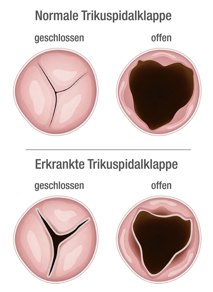 Trikuspidal-Clipping: Normale und erkrankte Trikuspidalklappe