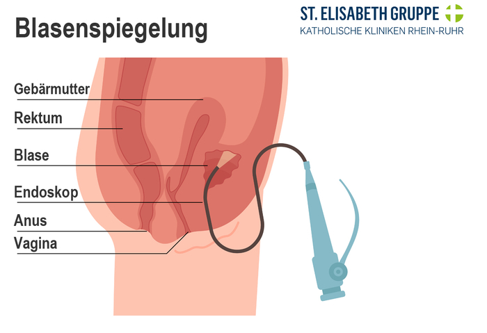 Blasenspiegelung bei Harninkontinenz Infografik