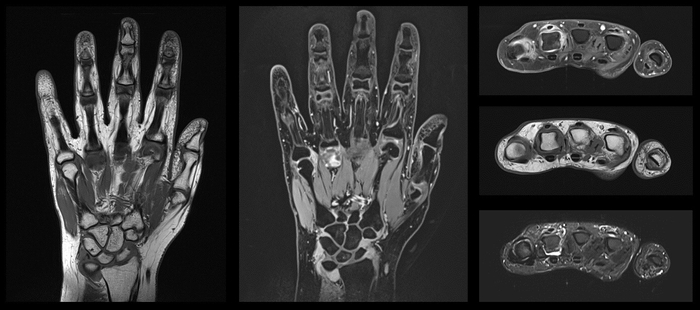 5 Bilder, die eine MRT-Darstellung einer rheumatisch-erkrankten Hand von vorne und von oben zeigen