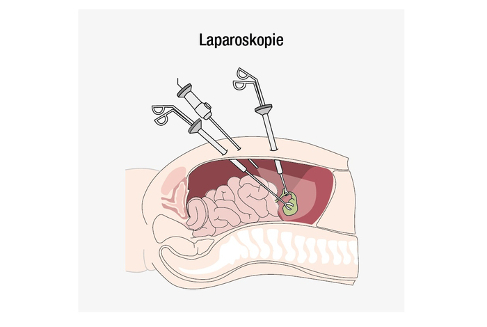 Die Abbildung zeigt eine Laparoskopie, eine minimal-invasive OP. bei der mit filigranem Operationsbesteck über kleine Schnitte im oberen Bauchraum die Gallenblase entfernt wird.d