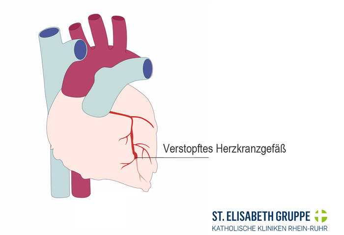 Verstopftes Herzkranzgefäß bei KHK