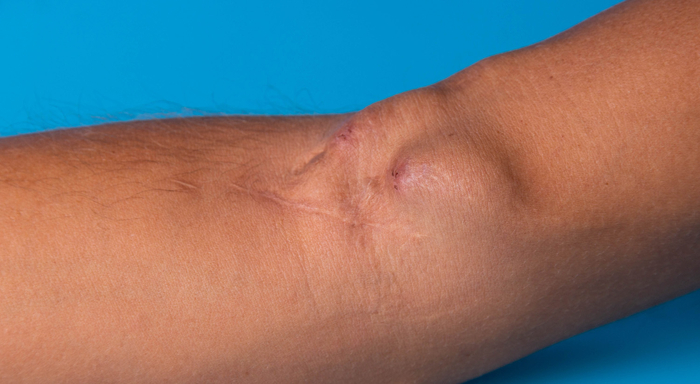Armbeuge mit einem Dialyseshunt, auch AV-Fistel genannt.