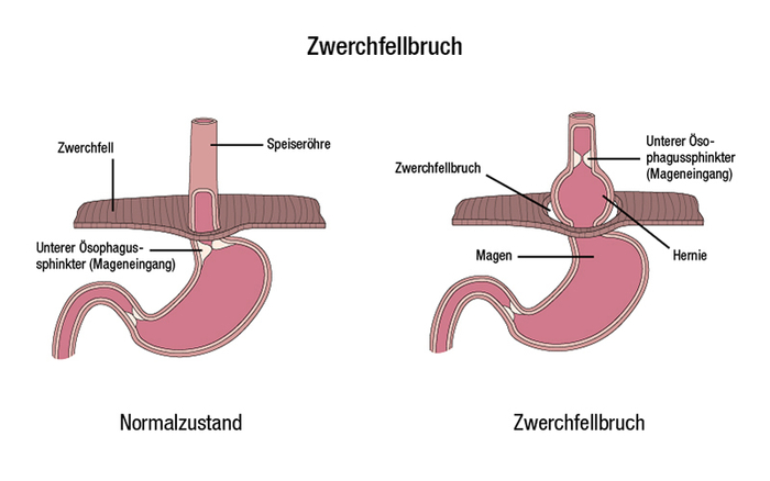 Diagramm eines Zwerchfellbruchs: eine häufige Ursache für die Refluxkrankheit