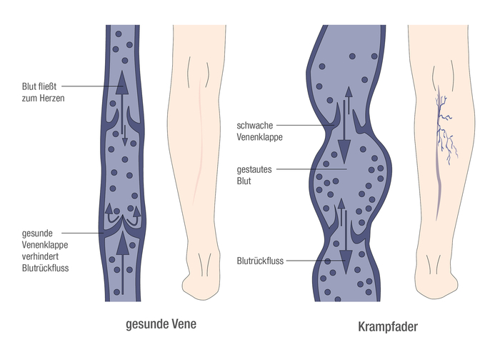 Grafik einer gesunden Vene und einer Krampfader im Vergleich: Während bei der gesunden Vene das Blut zum Herzen fließt, staut sich in der Krampfader das Blut.