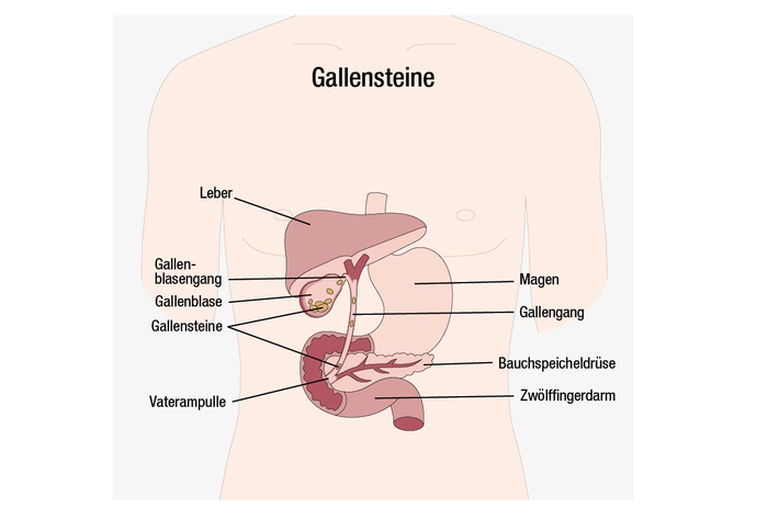 Ein Querschnitt eines Körpers ist zu sehen. Im Körper sind verschiedenen Organe, wie Gallenblase, Leber oder Magen in unterschiedlichen Farben dargestellt. Auch Gallensteine, die Gallenblase und Gallengänge verstopfen, kann man auf der Abbildung sehen.