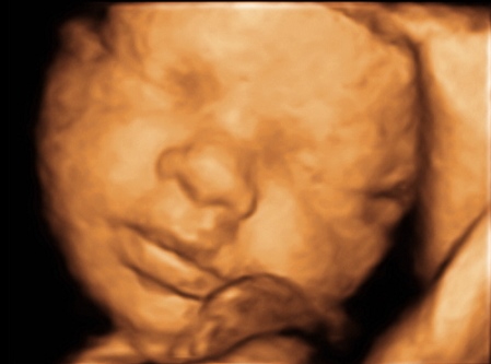 3D-Darstellung eines fetalen Gesichts im 3D-/4D-Ultraschall