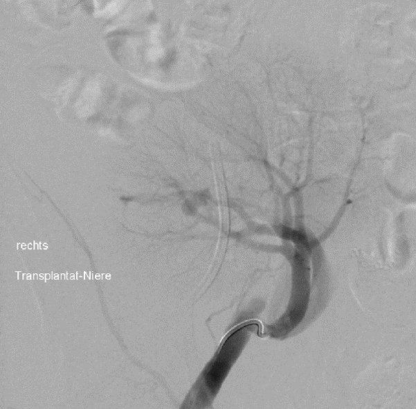 Darstellung der verletzten oder veränderten Arterie.