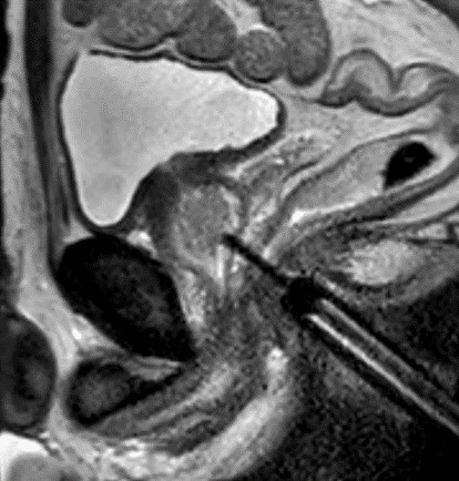 Transrektale MRT-gesteuerte Biopsie der Prostata