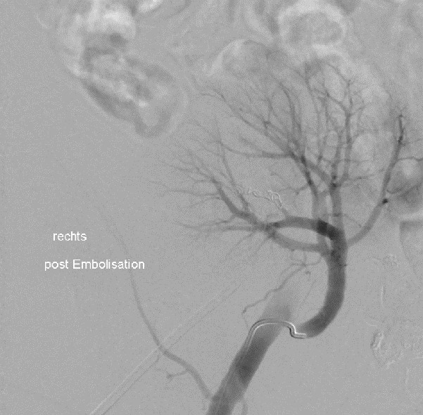 Verschlossene Arterie nach der Katheterbehandlung.