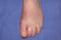 Postoperatives Resultat