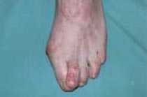 Hallux valgus
