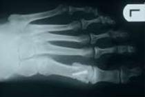 Radiologisches Bild nach Chevron Osteotomie