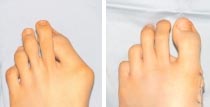 Ausgeprägter Hallux valgus und Korrekturergebnis nach durchgeführter diaphysärer Ludloff-Osteotomie