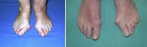 Hallux valgus Deformität bds. und Aufhebung der Fehlstellung am re. Fuß nach durchgeführter Lapidus-Operation