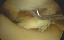 Knorpelschaden Femurcondyle