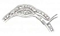 Retinaculanaht schematisch